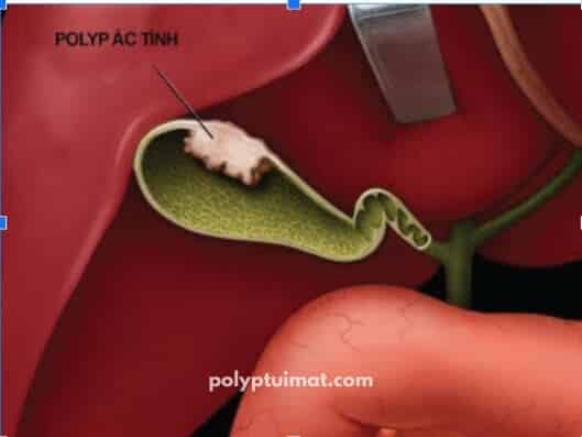 Cách nhận biết polyp túi mật có nguy cơ ung thư